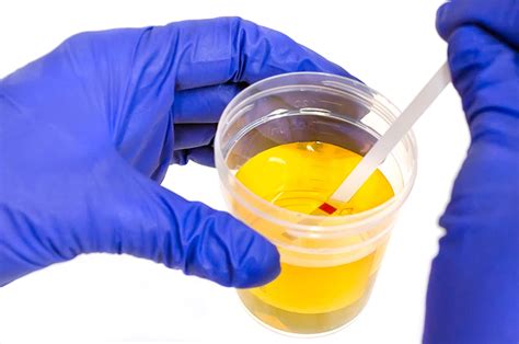 clinical urinalysis testing